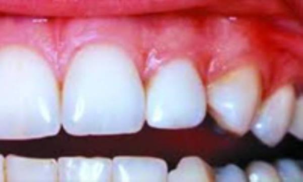 بهداشت دهان و دندان در مبتلایان به آسم